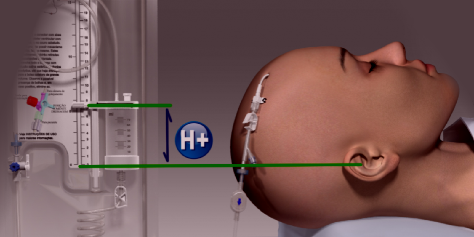 Derivação Ventricular Externa